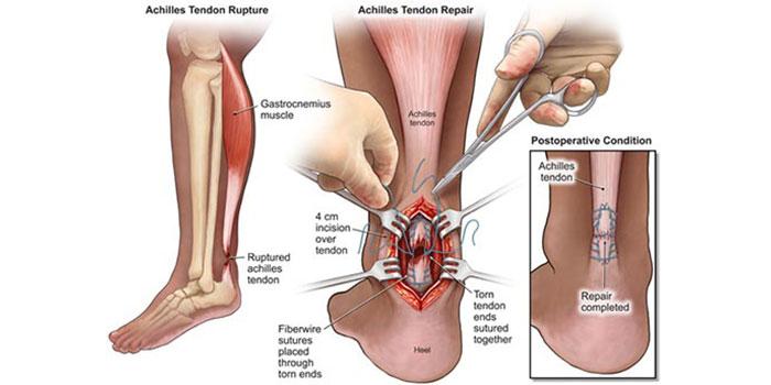 Tendon Repair Surgery